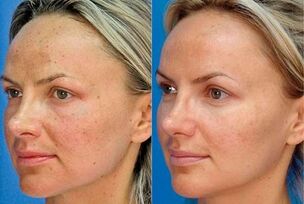 foto pirms un pēc ādas atjaunošanas ar ierīci